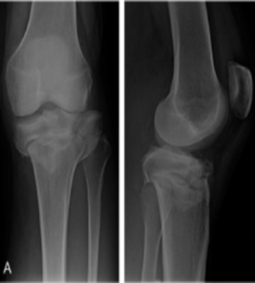 News - Bicondylar tibial plateau fracture with hyperextension and varus（1）